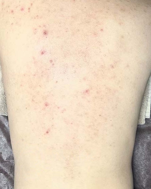 After treatment