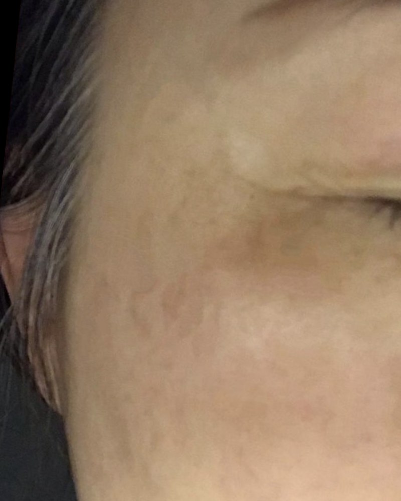 After treatment
