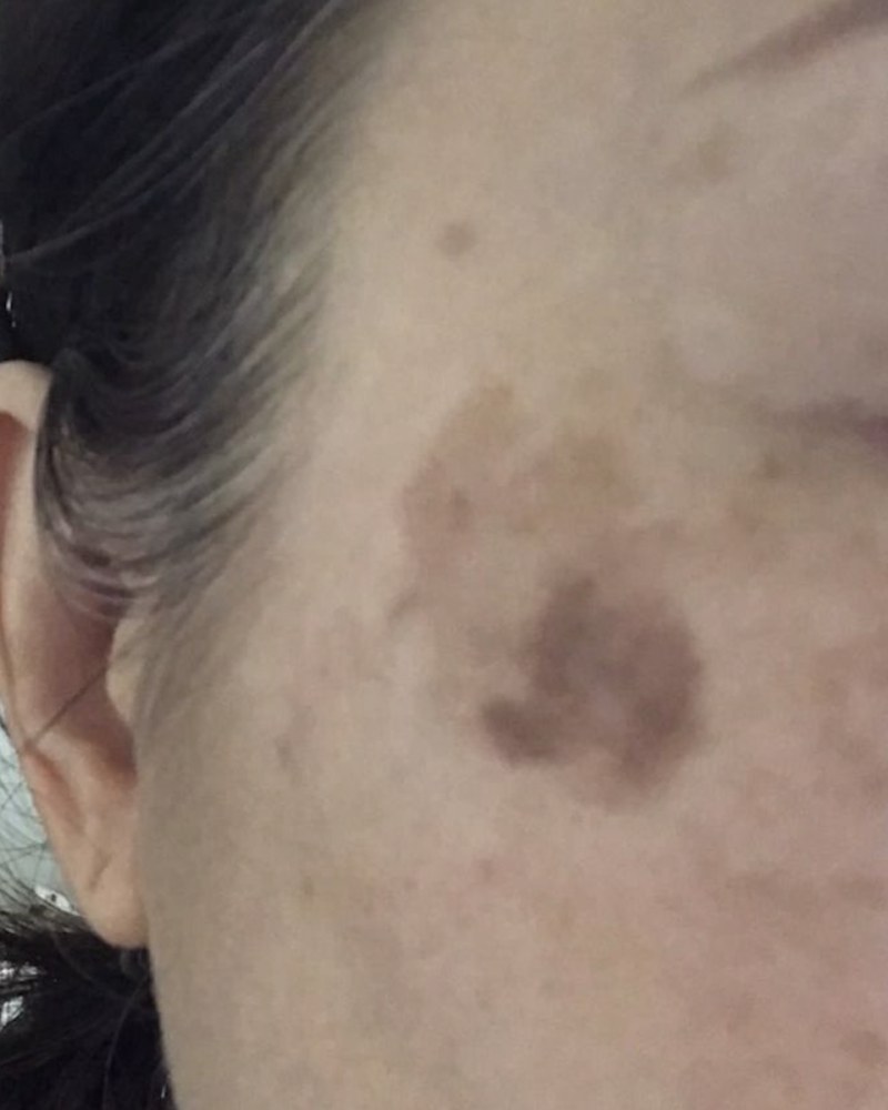 Before treatment